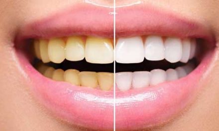 5 maneras de deshacerse de los dientes amarillos