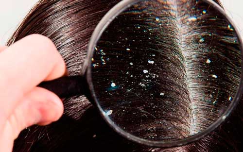 7 remedios caseros fáciles para deshacerse de la caspa
