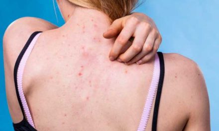 Cómo deshacerse del acné en la espalda