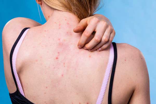 Cómo deshacerse del acné en la espalda