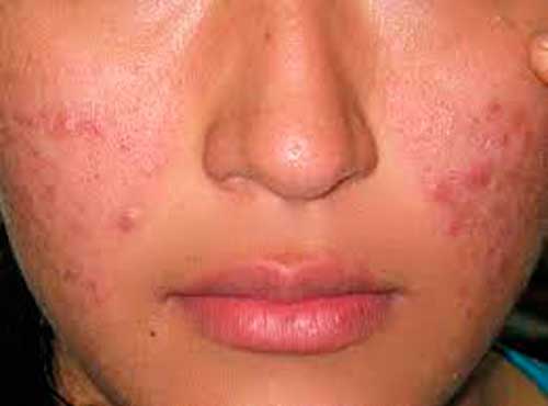 Cómo deshacerse de las espinillas, según los dermatólogos