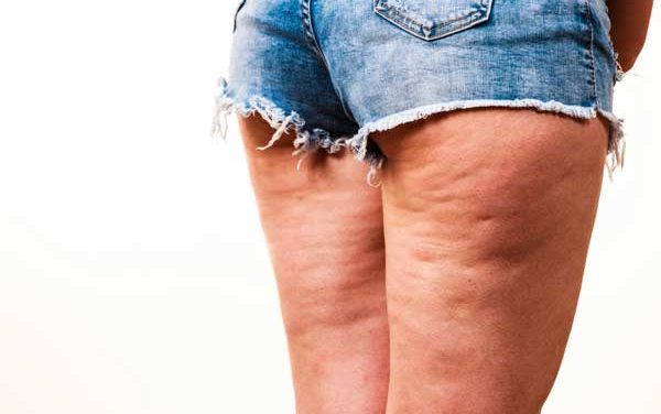 Lo que necesitas saber sobre la celulitis.