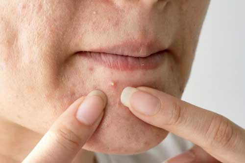 5 razones del porque sale acné