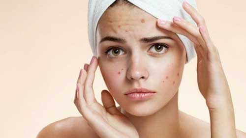 remedios caseros para el acné