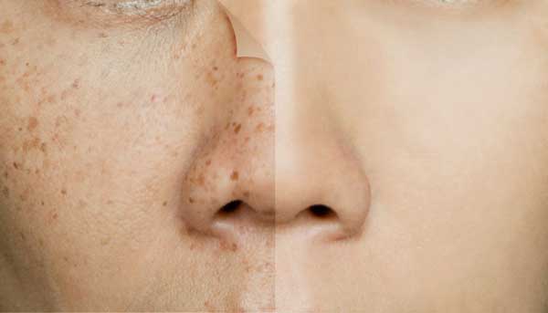 Manchas en la piel : causas, tratamientos y cómo prevenirlas
