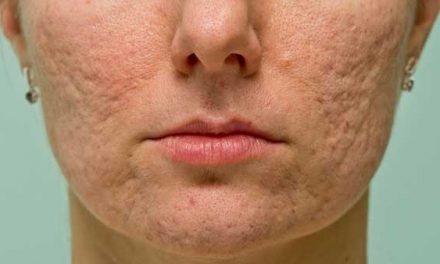 Cicatrices de acné: ¿Cuál es el mejor tratamiento?