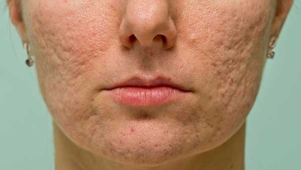 Cicatrices de acné: ¿Cuál es el mejor tratamiento?