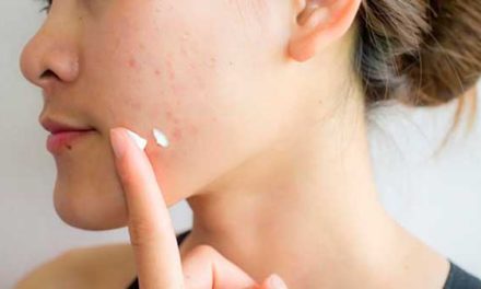 ¿Cómo eliminar las cicatrices del acné de la cara?