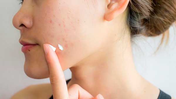 ¿Cómo eliminar las cicatrices del acné de la cara?