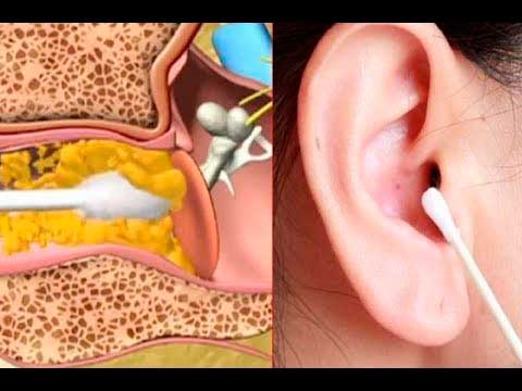 Cómo limpiar de forma segura tus oídos en casa