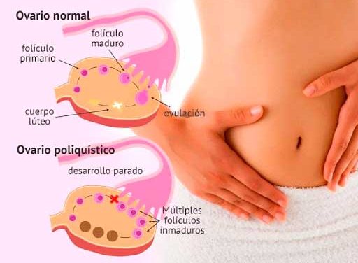 5 alimentos para aliviar los síntomas del síndrome de ovario poliquístico